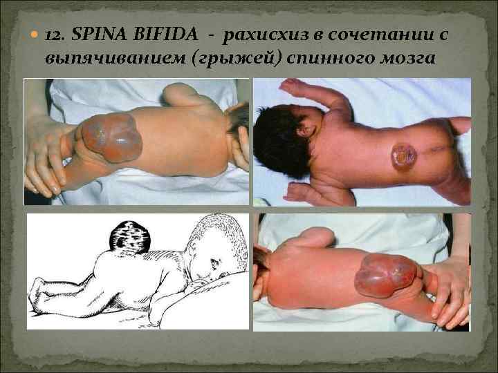  12. SPINA BIFIDA - рахисхиз в сочетании с выпячиванием (грыжей) спинного мозга 