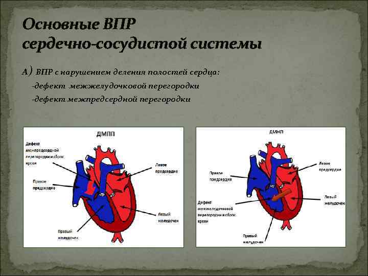 Основные ВПР сердечно-сосудистой системы А) ВПР с нарушением деления полостей сердца: -дефект межжелудочковой перегородки