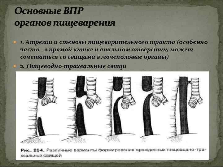 Основные ВПР органов пищеварения 1. Атрезии и стенозы пищеварительного тракта (особенно часто - в