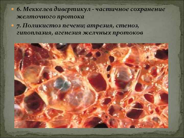  6. Меккелев дивертикул - частичное сохранение желточного протока 7. Поликистоз печени; атрезия, стеноз,