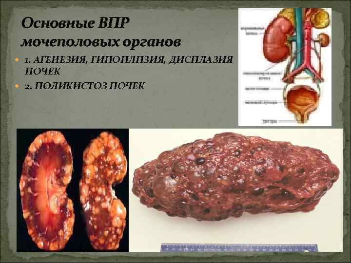 Основные ВПР мочеполовых органов 1. АГЕНЕЗИЯ, ГИПОПЛПЗИЯ, ДИСПЛАЗИЯ ПОЧЕК 2. ПОЛИКИСТОЗ ПОЧЕК 