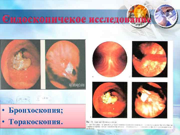 Эндоскопичекое исследование • Бронхоскопия; • Торакоскопия. 
