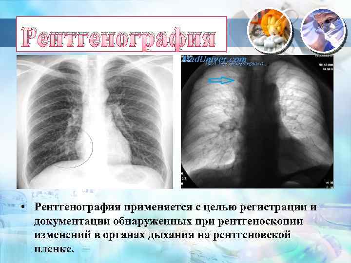 Рентгенография • Рентгенография применяется с целью регистрации и документации обнаруженных при рентгеноскопии изменений в