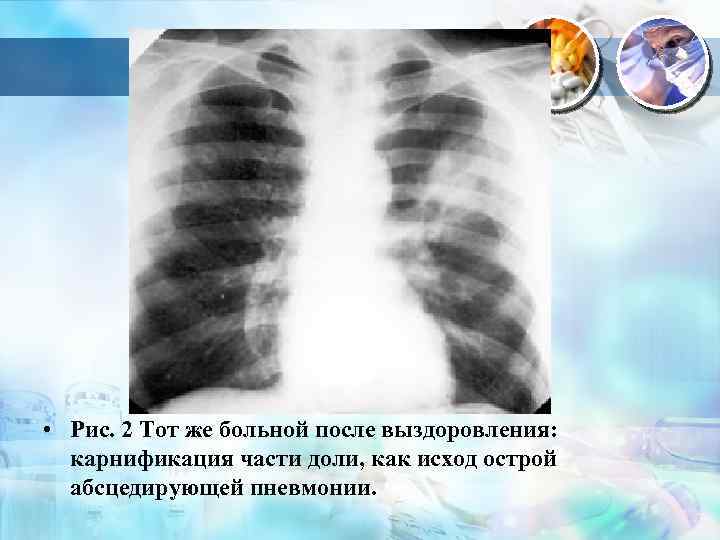  • Рис. 2 Тот же больной после выздоровления: карнификация части доли, как исход