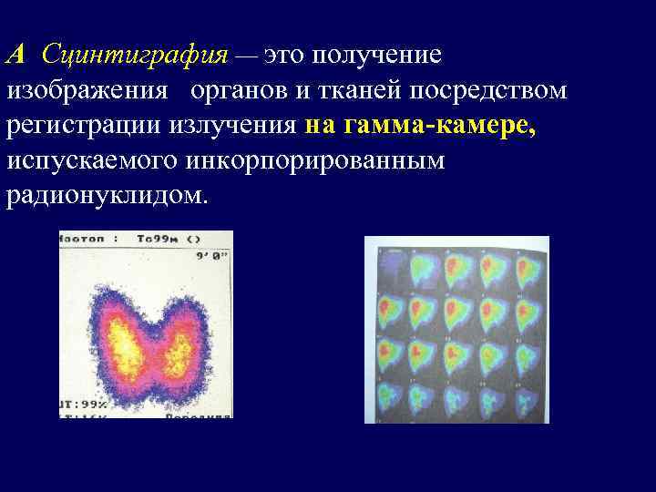 А Сцинтиграфия — это получение изображения органов и тканей посредством регистрации излучения на гамма-камере,