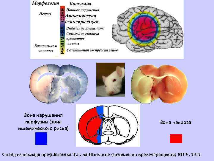 Аноксическая деполяризация Зона нарушения перфузии (зона ишемического риска) Зона некроза Слайд из доклада проф.