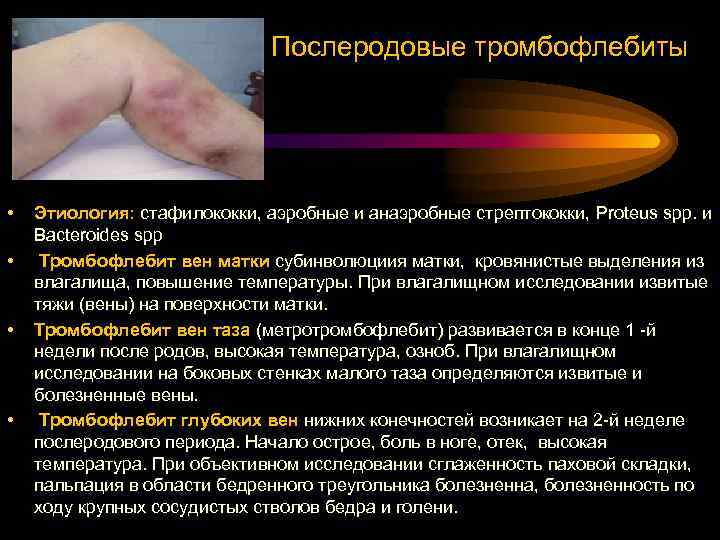 Послеродовые тромбофлебиты • • Этиология: стафилококки, аэробные и анаэробные стрептококки, Proteus spp. и Bacteroides