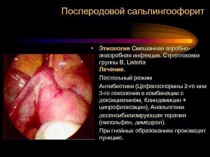 Послеродовой сальпингоофорит • Этиология Смешанная аэробноанаэробная инфекция. Стрептококки группы В, Listeria Лечение. • Постельный