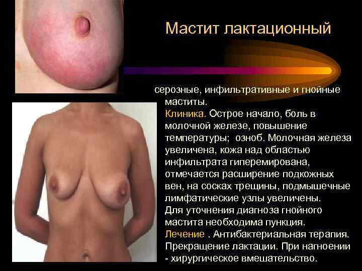 Мастит лактационный серозные, инфильтративные и гнойные маститы. Клиника. Острое начало, боль в молочной железе,