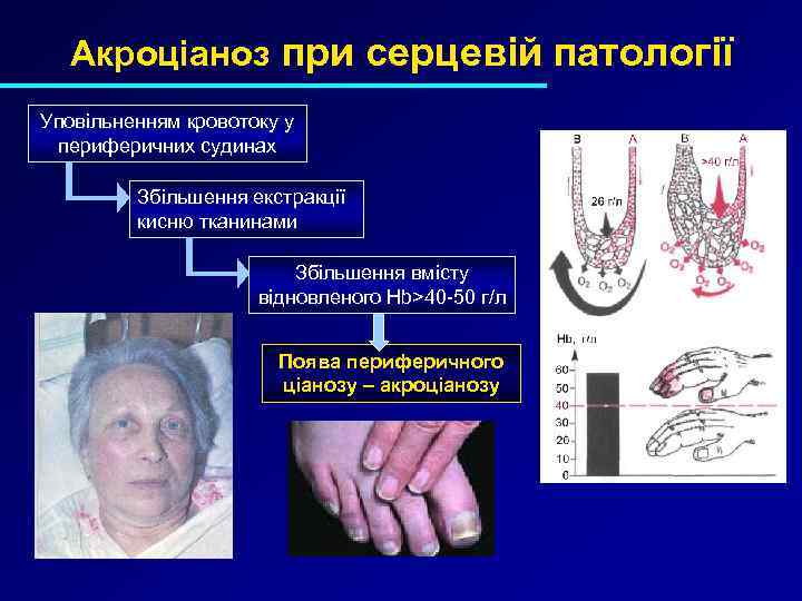 Акроціаноз при серцевій патології Уповільненням кровотоку у периферичних судинах Збільшення екстракції кисню тканинами Збільшення