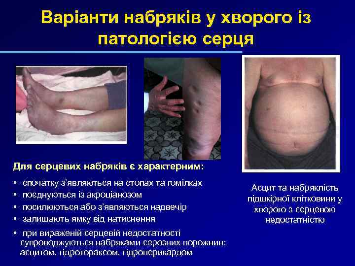 Варіанти набряків у хворого із патологією серця Для серцевих набряків є характерним: • •