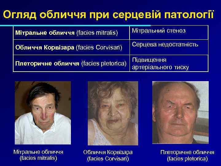 Огляд обличчя при серцевій патології Мітральне обличчя (facies mitralis) Мітральний стеноз Обличчя Корвізара (facies