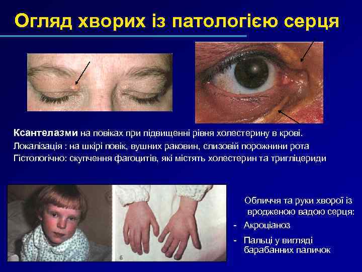 Огляд хворих із патологією серця Ксантелазми на повіках при підвищенні рівня холестерину в крові.