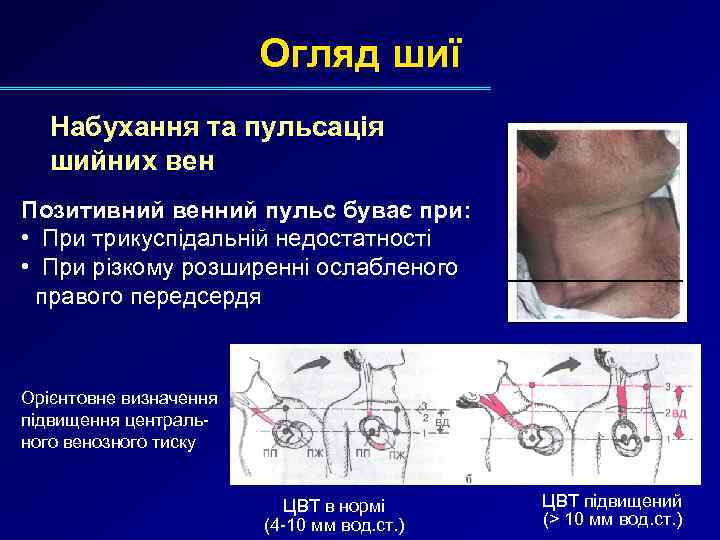 Огляд шиї Набухання та пульсація шийних вен Позитивний венний пульс буває при: • При