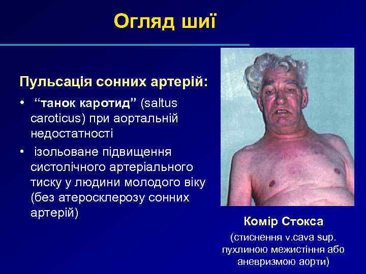 Огляд шиї Пульсація сонних артерій: • “танок каротид” (saltus caroticus) при аортальній недостатності •