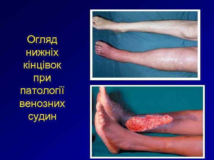 Огляд нижніх кінцівок при патології венозних судин 