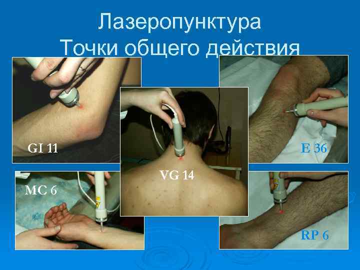 Лазеропунктура Точки общего действия GI 11 MC 6 E 36 VG 14 RP 6