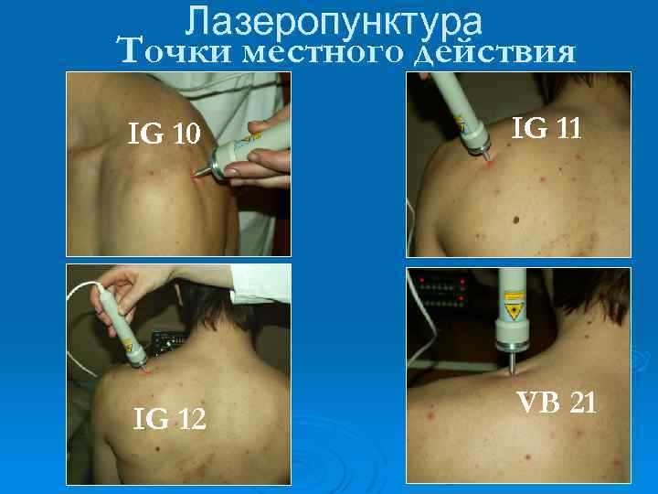 Лазеропунктура Точки местного действия IG 10 IG 11 IG 12 VB 21 