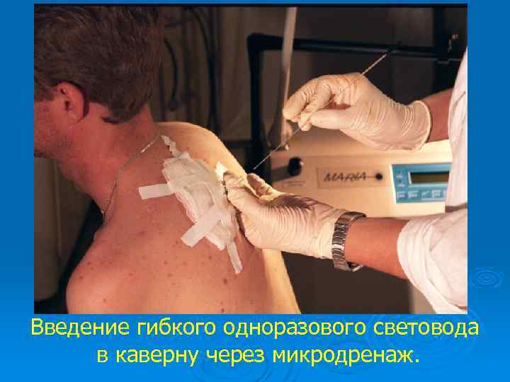 Введение гибкого одноразового световода в каверну через микродренаж. 