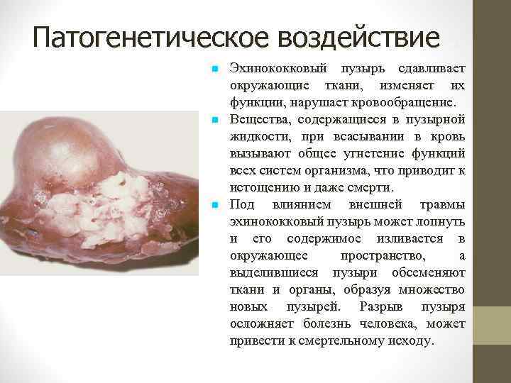 Патогенетическое воздействие. Эхинококковый пузырь сдавливает окружающие ткани, изменяет их функции, нарушает кровообращение. Вещества, содержащиеся