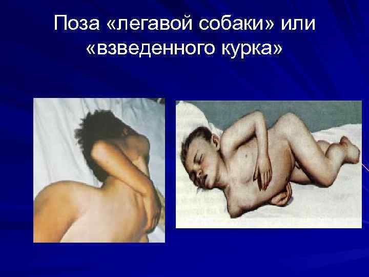 Поза «легавой собаки» или «взведенного курка» 