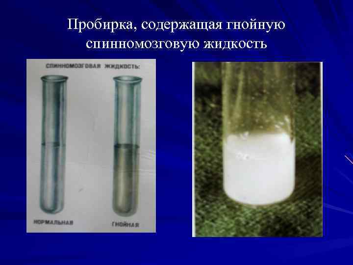 Пробирка, содержащая гнойную спинномозговую жидкость 