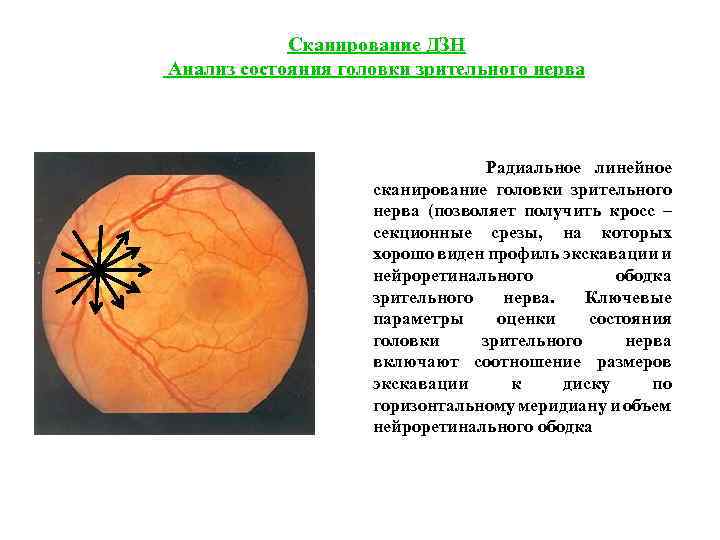 Сканирование ДЗН Анализ состояния головки зрительного нерва Радиальное линейное сканирование головки зрительного нерва (позволяет