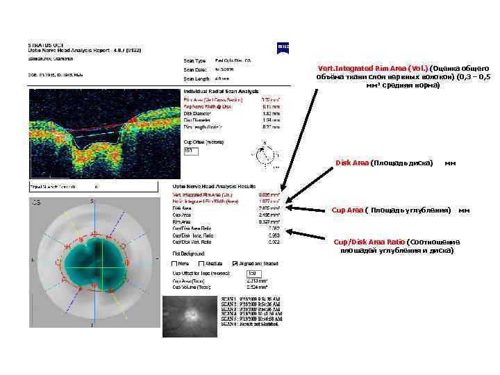 Vert. Integrated Rim Area (Vol. ) (Оценка общего (Оценка общ объёма ткани слоя нервных