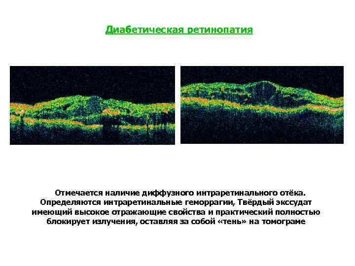 Диабетическая ретинопатия Отмечается наличие диффузного интраретинального отёка. Определяются интраретинальные геморрагии, Твёрдый экссудат имеющий высокое