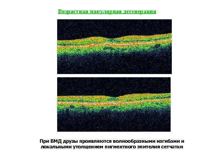 Возрастная макулярная дегенерация При ВМД друзы проявляются волнообразными изгибами и локальными утолщением пигментного эпителия