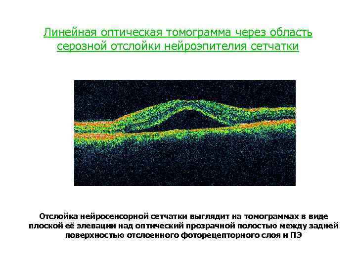 Линейная оптическая томограмма через область серозной отслойки нейроэпителия сетчатки Отслойка нейросенсорной сетчатки выглядит на