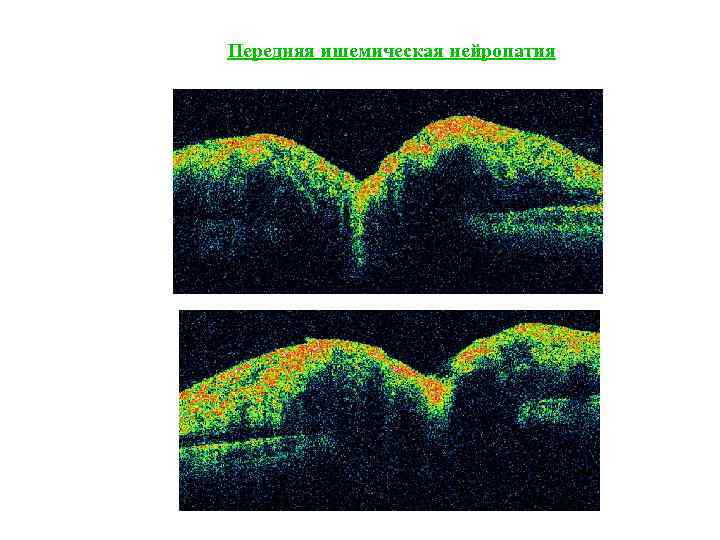 Передняя ишемическая нейропатия 