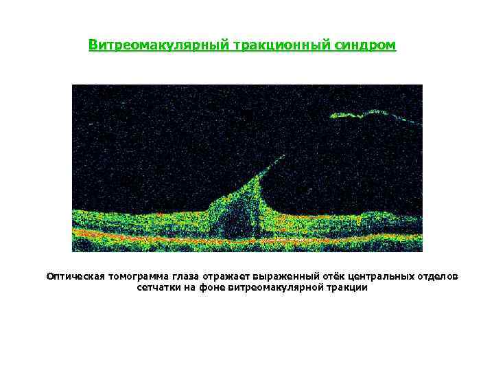 Оптическая когерентная томография схема