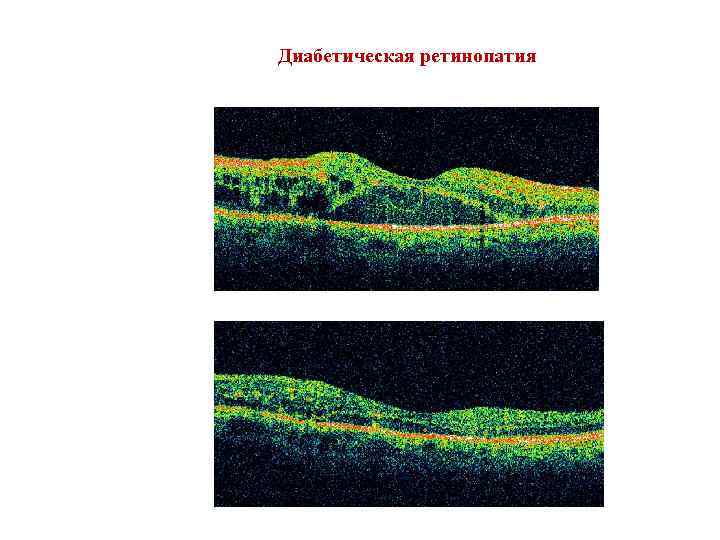 Диабетическая ретинопатия 