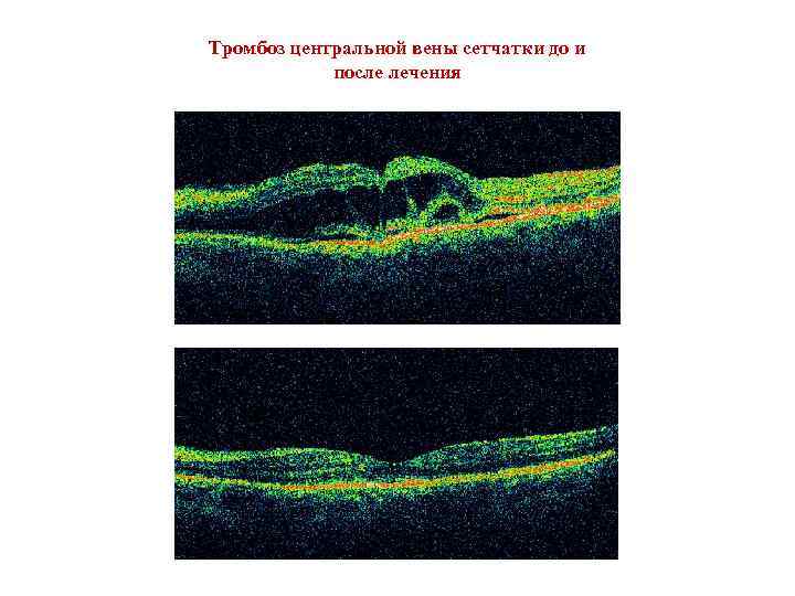 Тромбоз центральной вены сетчатки до и после лечения 