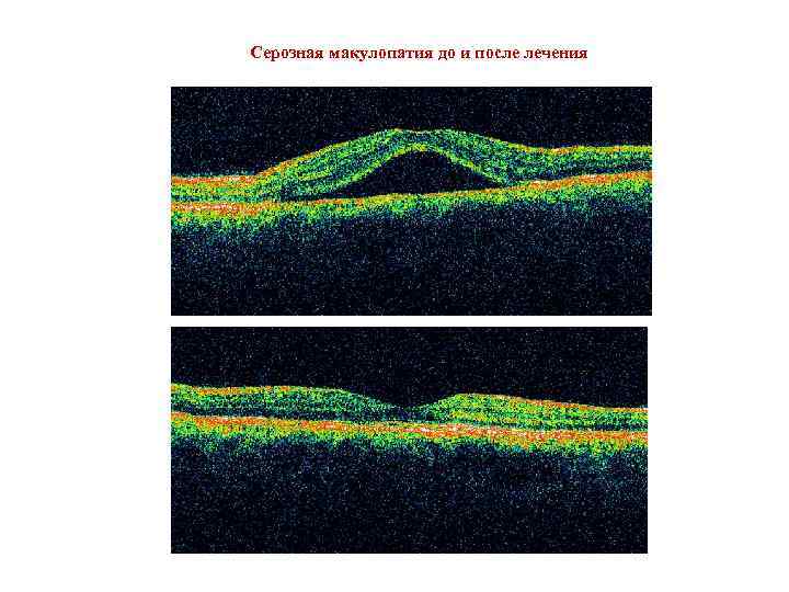 Серозная макулопатия до и после лечения 