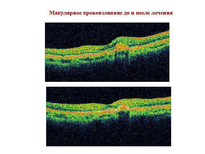 Макулярное кровоизлияние до и после лечения 
