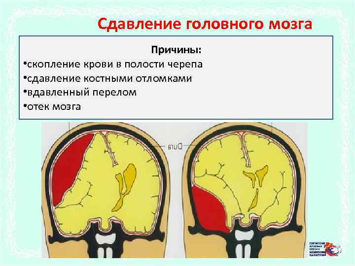 Сдавление головного мозга Причины: • скопление крови в полости черепа • сдавление костными отломками