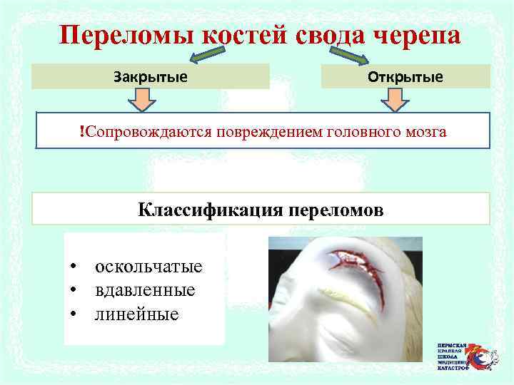 Переломы костей свода черепа Закрытые Открытые !Сопровождаются повреждением головного мозга Классификация переломов • оскольчатые