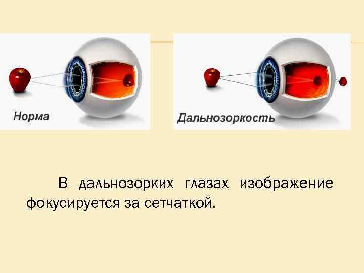 В дальнозорких глазах изображение фокусируется за сетчаткой. 