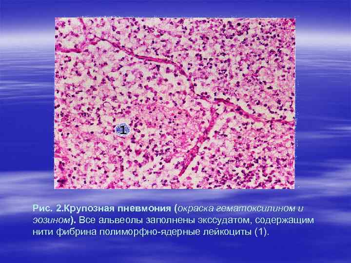 Рис. 2. Крупозная пневмония (окраска гематоксилином и эозином). Все альвеолы заполнены экссудатом, содержащим нити