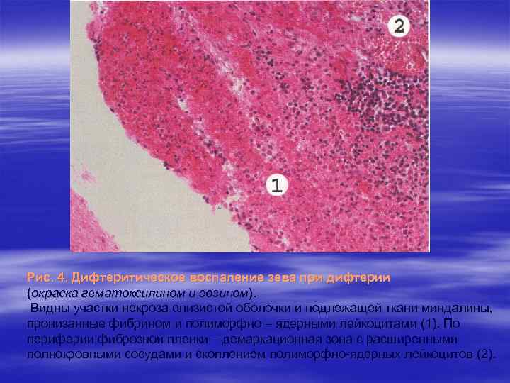 Рис. 4. Дифтеритическое воспаление зева при дифтерии (окраска гематоксилином и эозином). Видны участки некроза