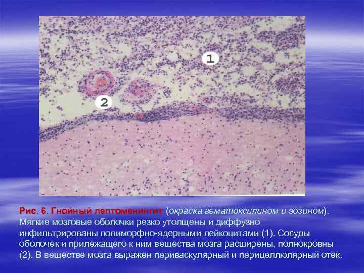 Рис. 6. Гнойный лептоменингит (окраска гематоксилином и эозином). Мягкие мозговые оболочки резко утолщены и