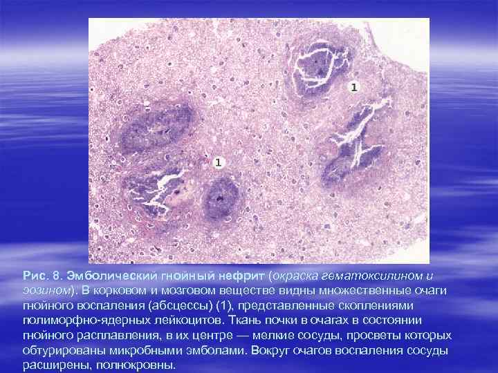 Рис. 8. Эмболический гнойный нефрит (окраска гематоксилином и эозином). В корковом и мозговом веществе