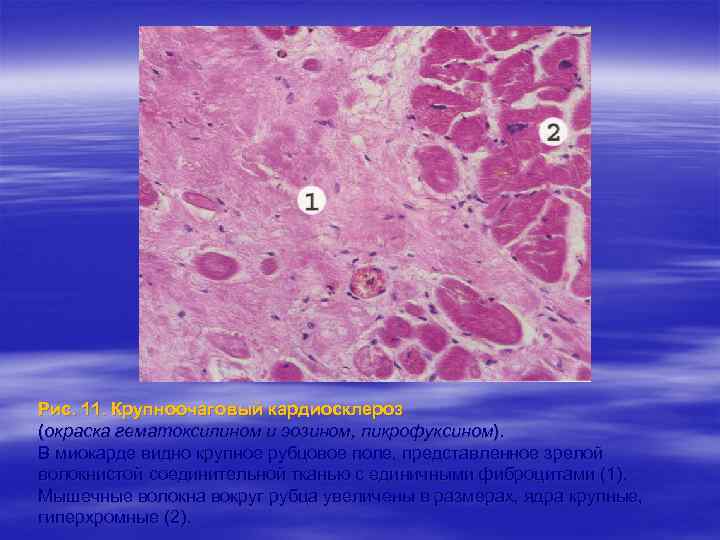 Рис. 11. Крупноочаговый кардиосклероз (окраска гематоксилином и эозином, пикрофуксином). В миокарде видно крупное рубцовое