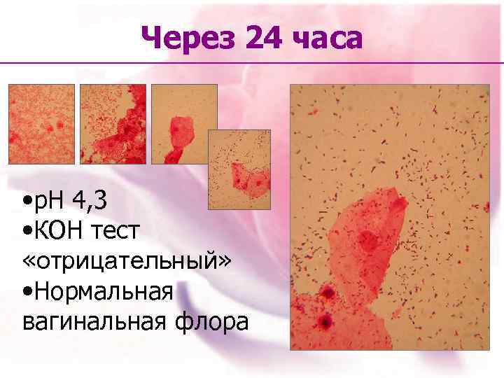 Через 24 часа • р. Н 4, 3 • КОН тест «отрицательный» • Нормальная