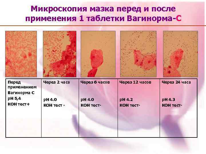 Микроскопия мазка перед и после применения 1 таблетки Вагинорма-С Перед применением Вагинорма С р.