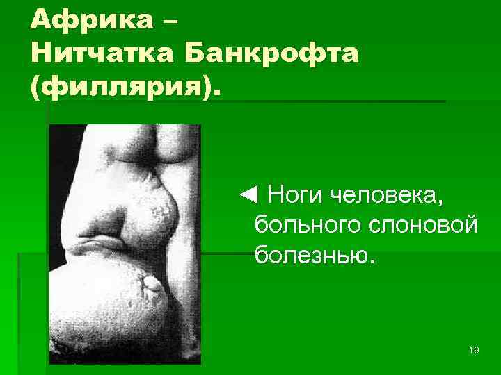 Африка – Нитчатка Банкрофта (филлярия). ◄ Ноги человека, больного слоновой болезнью. 19 