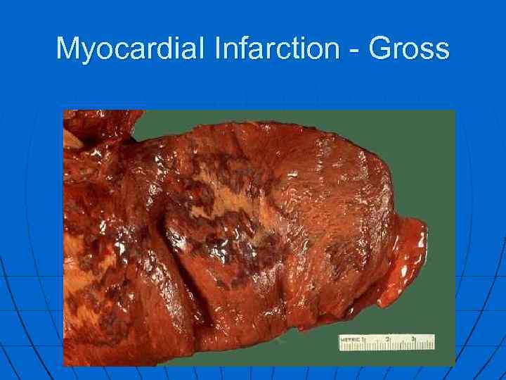 Myocardial Infarction - Gross 