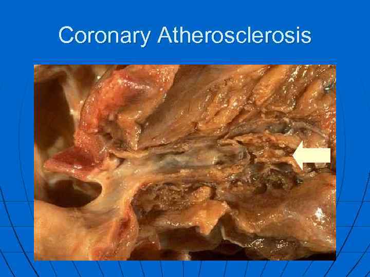 Coronary Atherosclerosis 